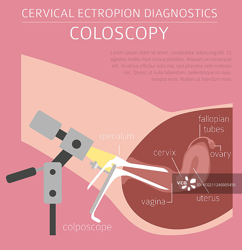 妇科疾病图片素材