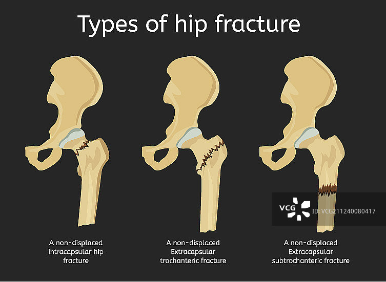 髋部骨折类型图片素材