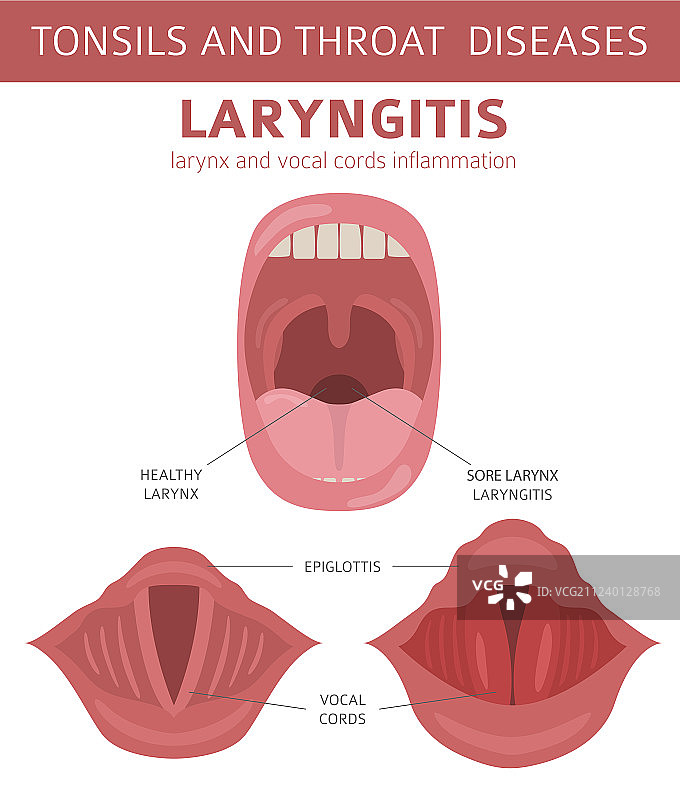 扁桃体和咽喉疾病喉炎症状图片素材