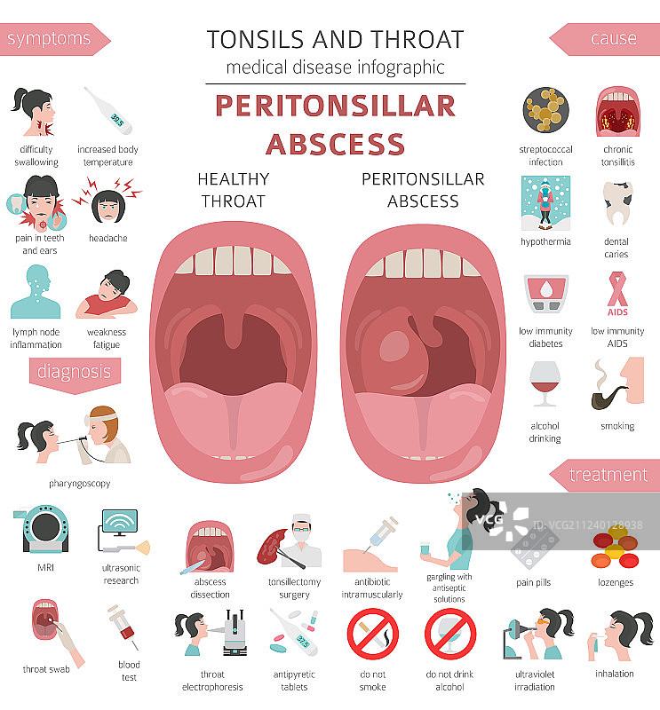 扁桃体和咽喉疾病：扁桃体周围脓肿图片素材