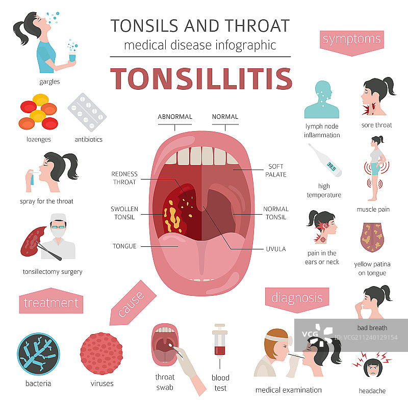 扁桃体和咽喉疾病扁桃体炎症状图片素材