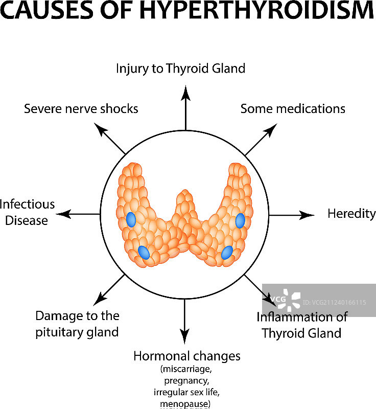 甲状腺机能亢进的原因图片素材