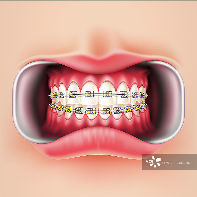 3D牙齿矫正器图片素材