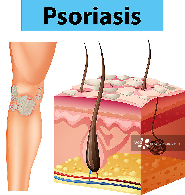 人体皮肤牛皮癣示意图图片素材