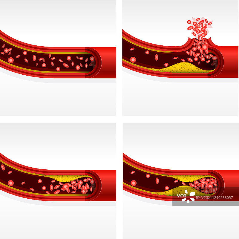 含有胆固醇和血栓的动脉切面图片素材
