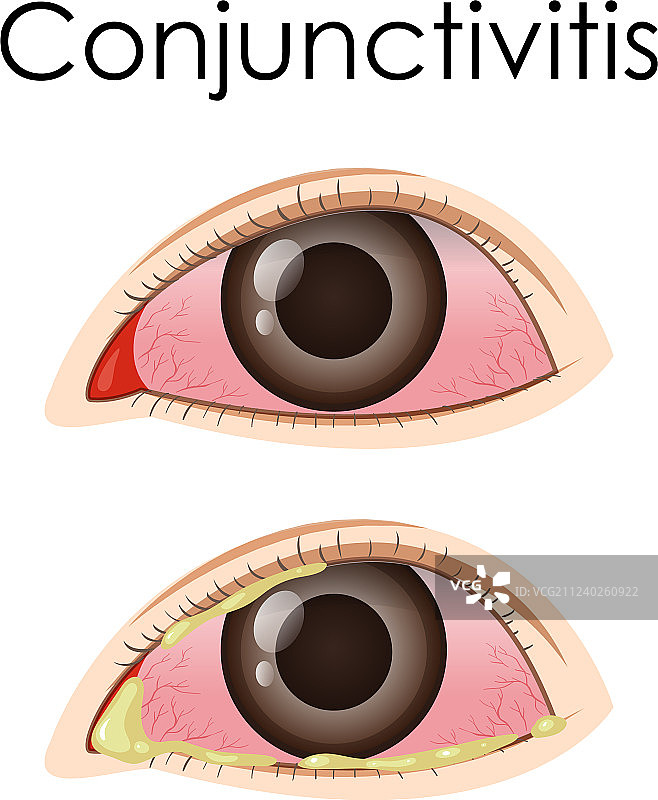 人类结膜炎图解图片素材