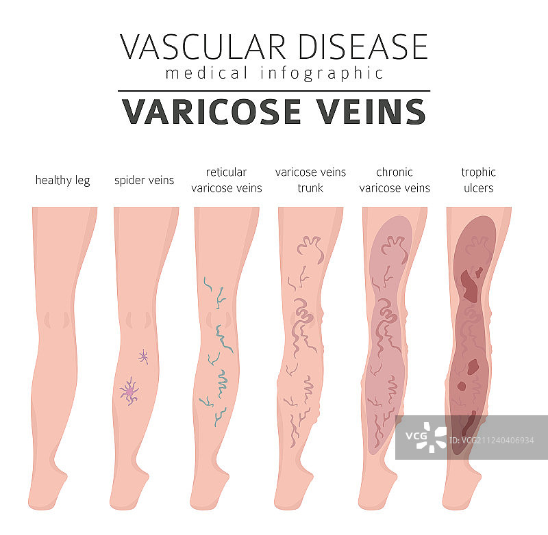 血管疾病静脉曲张症状图片素材