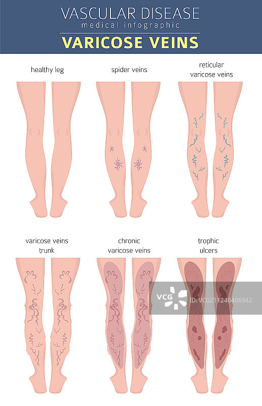 血管疾病静脉曲张症状图片素材