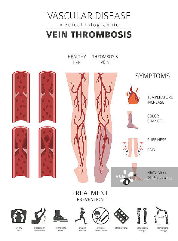 血管疾病静脉血栓症状图片素材