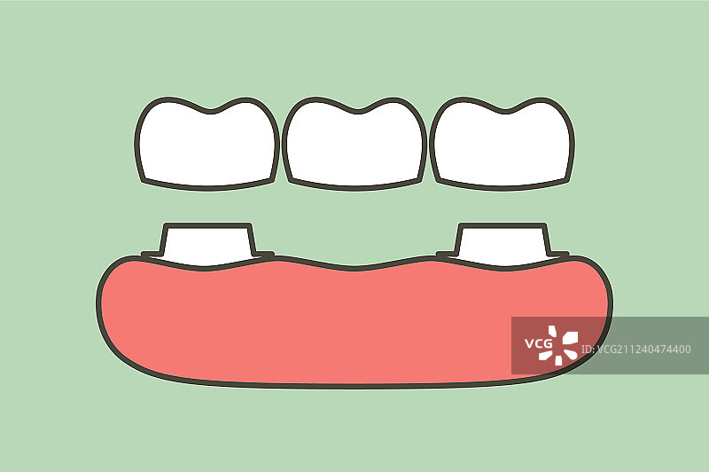 牙科牙冠与牙桥图片素材