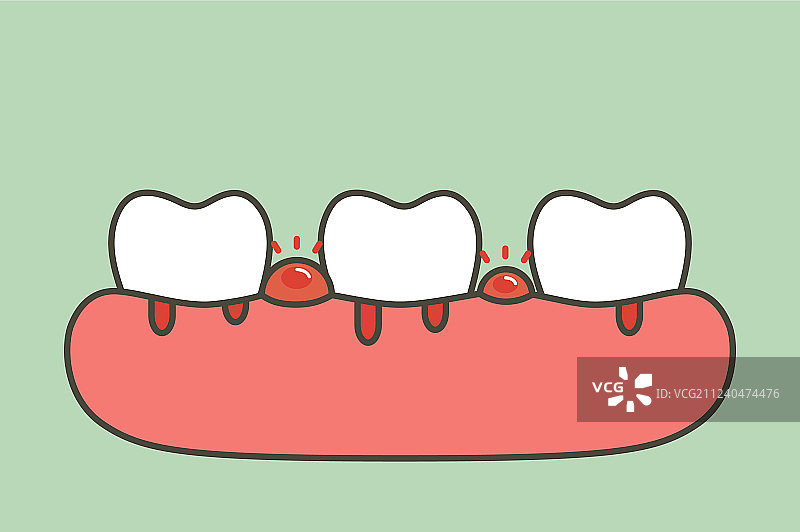 牙周炎或伴有出血的牙龈疾病图片素材