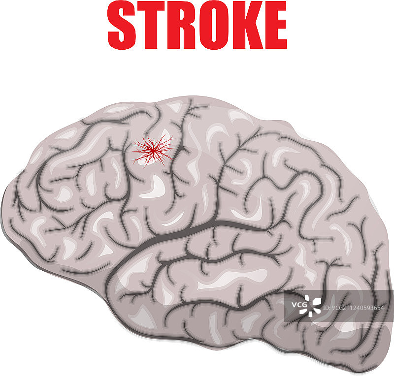 出血性中风图片素材