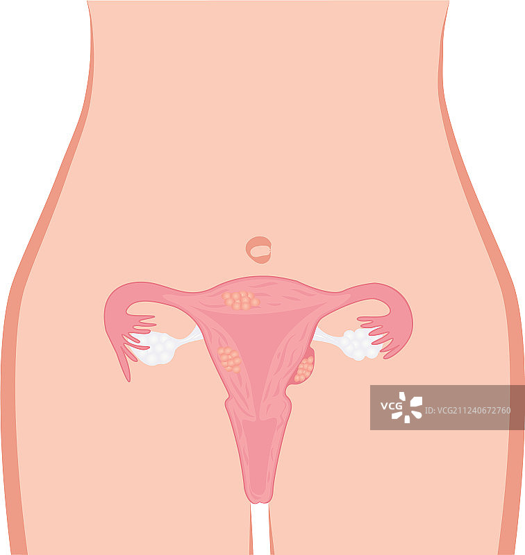 子宫肌瘤图片素材