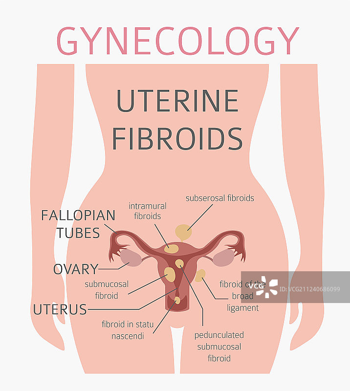子宫肌瘤妇科医学疾病图片素材