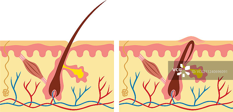 正常毛发与内生毛发的人体皮肤解剖图图片素材