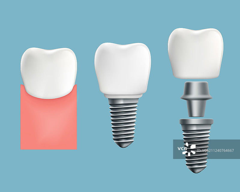 人类牙齿和植入物的示意图信息图图片素材