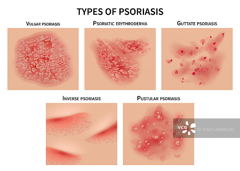 银屑病皮肤荨麻疹皮肤病类型图片素材