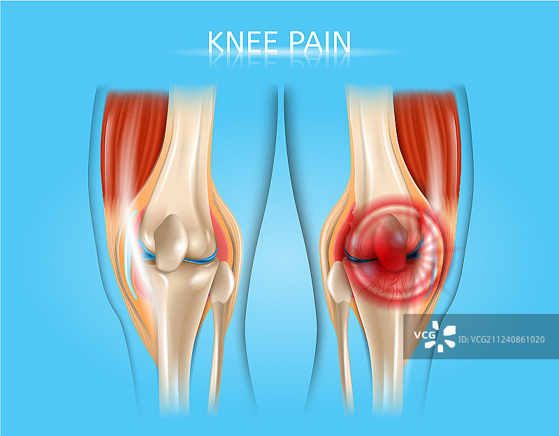 逼真解剖膝盖疼痛图片素材