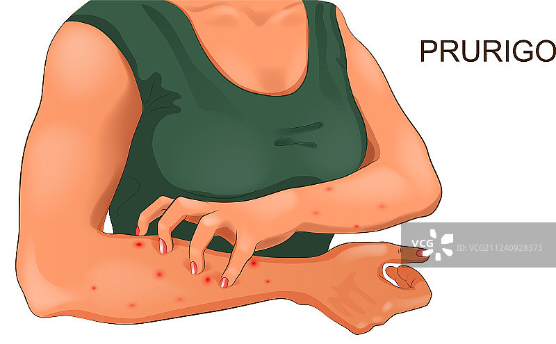 皮肤过敏瘙痒图片素材