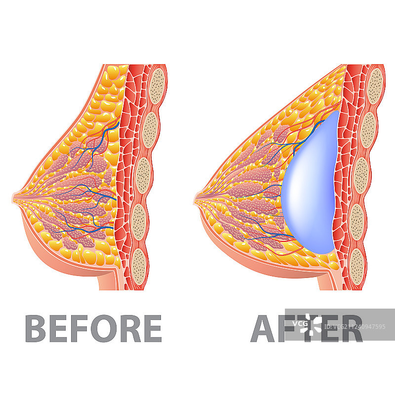 隆胸前后对比（白色背景，已隔离）图片素材