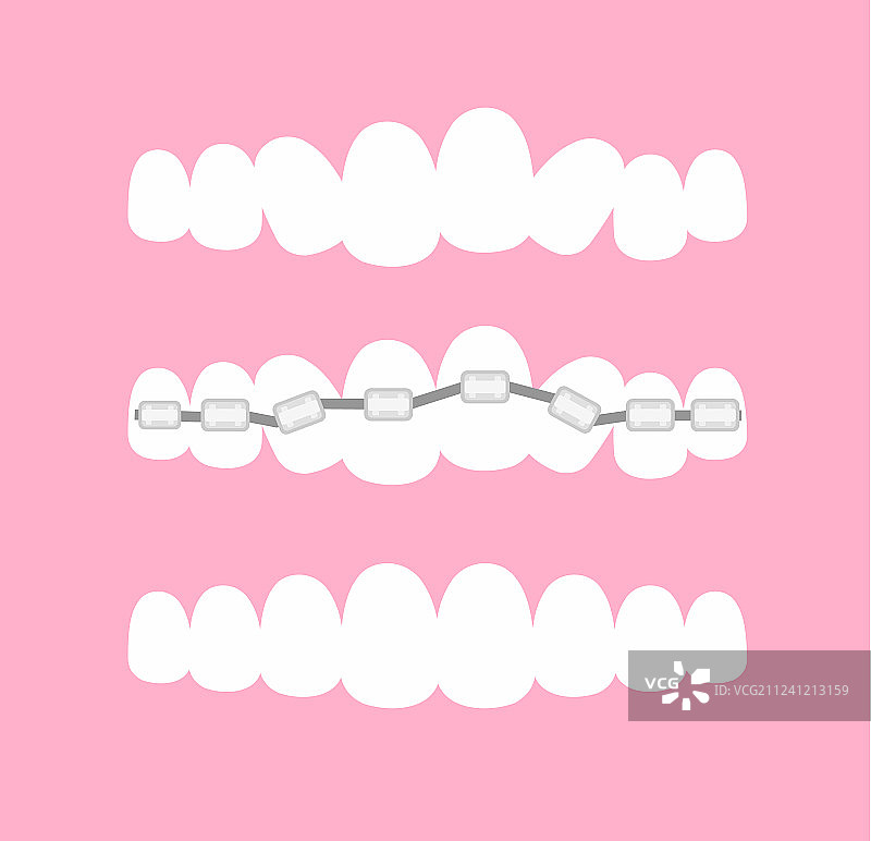 正畸阶段图片素材