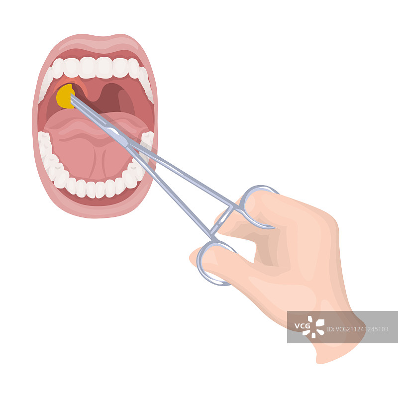 口腔扁桃体治疗图片素材