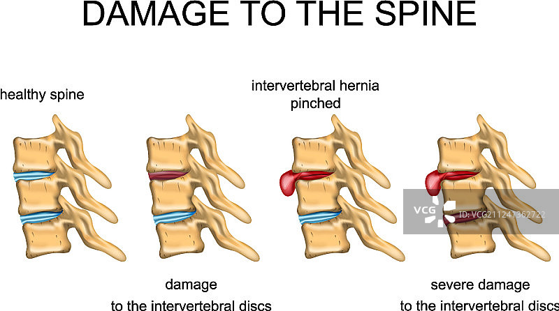 脊椎损伤图片素材