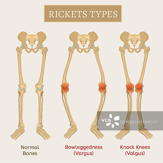 佝偻病方案图片素材