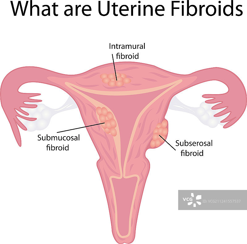 子宫肌瘤的类型图片素材