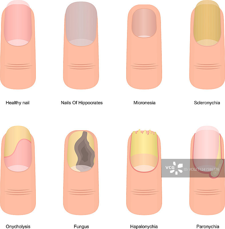 卡通彩色指甲疾病图标合集图片素材