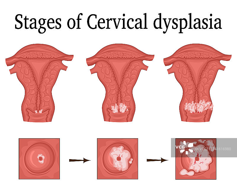 宫颈发育不良图片素材