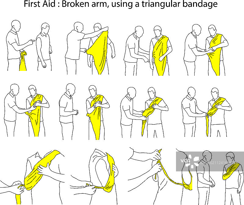 用三角绷带固定骨折的手臂图片素材