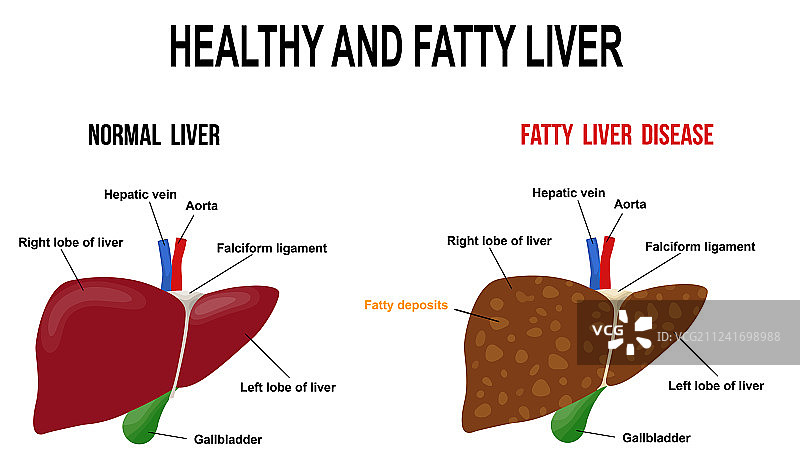 健康的脂肪肝图片素材