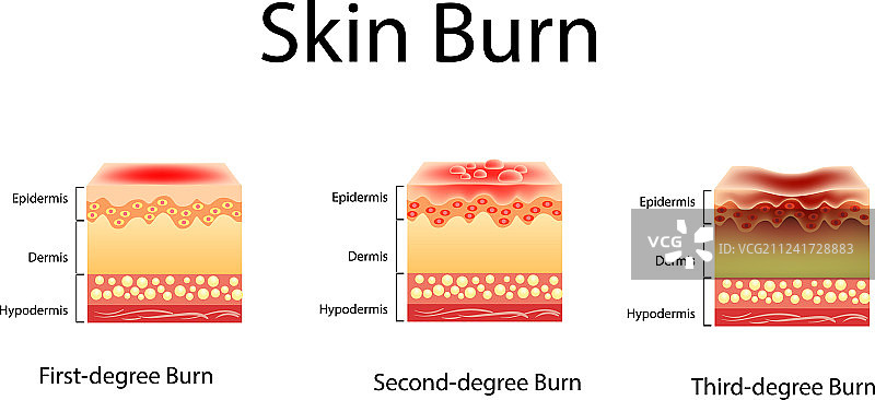 三度皮肤烧伤图片素材