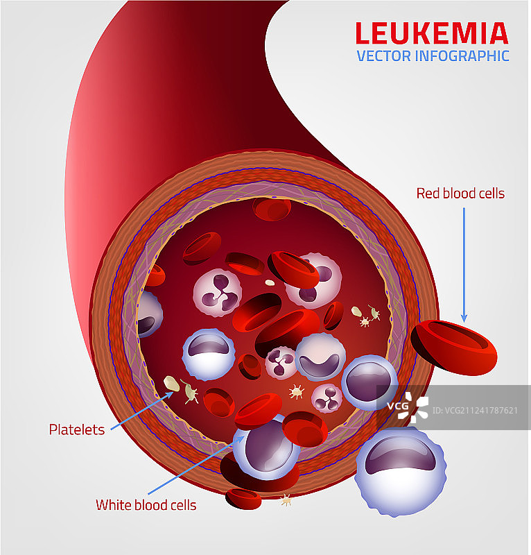 白血病医学信息图图片素材