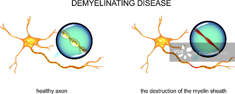 脱髓鞘疾病神经元图片素材