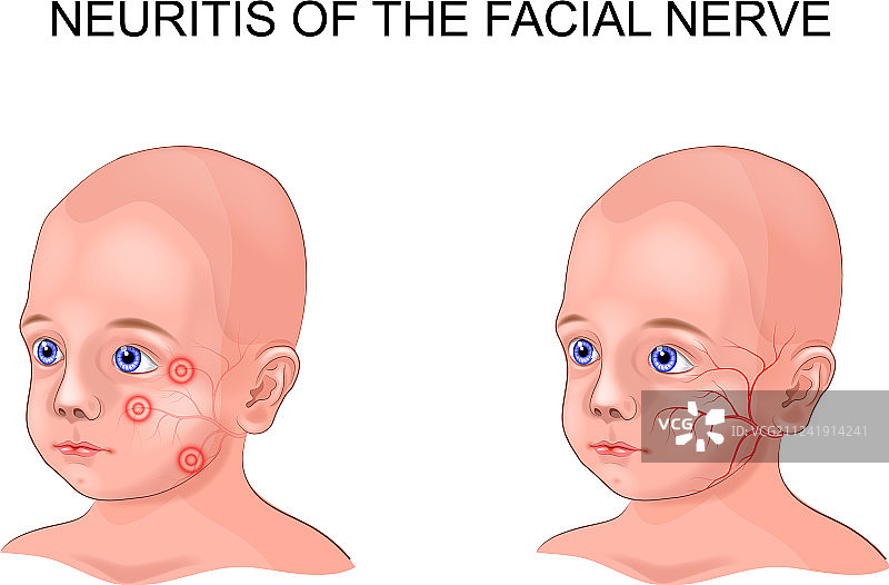 儿童面神经炎图片素材