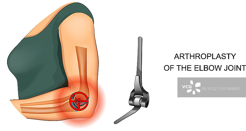 肘关节内假体图片素材