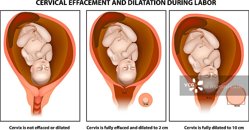 宫颈管消失及宫口扩张图片素材