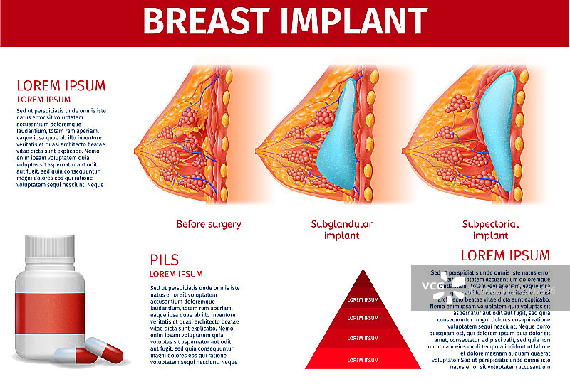 隆胸植入解剖结构banner（可复制）图片素材