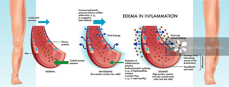 炎症水肿图片素材