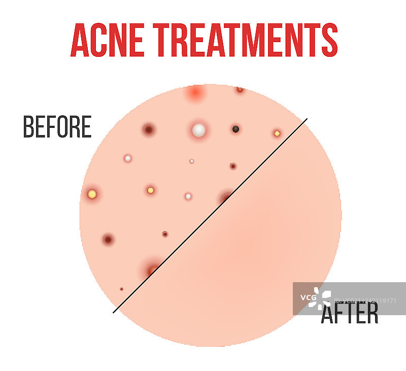 创意痤疮类型图片素材