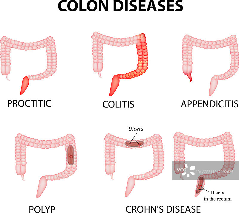 结肠疾病：直肠炎、结肠炎、阑尾炎图片素材