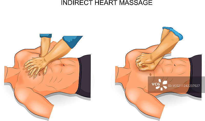 间接心脏按摩方法图片素材