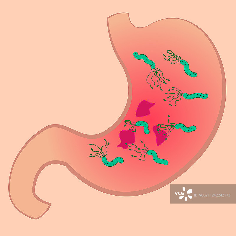 胃溃疡和幽门螺杆菌图片素材