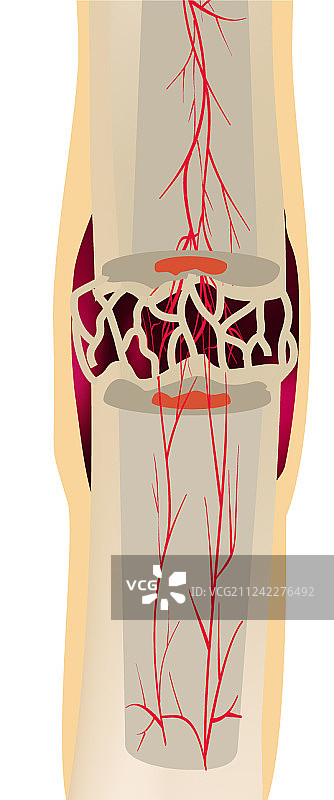 骨折愈合骨痂的三个阶段图片素材