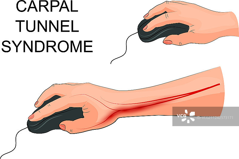 腕管综合征图片素材