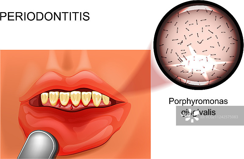 牙周炎出血的牙龈图片素材