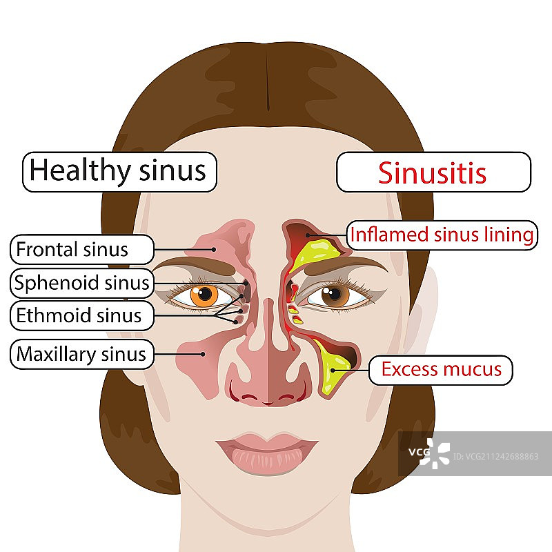 鼻窦炎图片素材