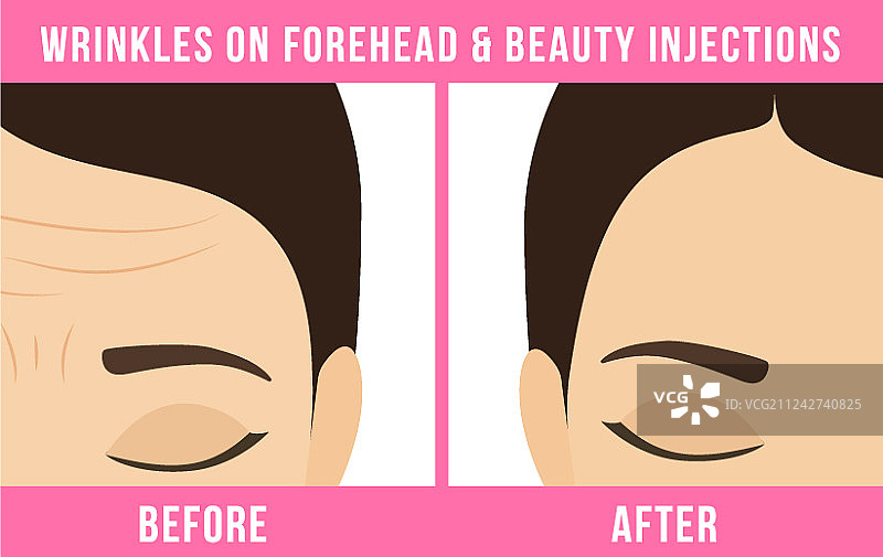 美容程序：肉毒杆菌图片素材